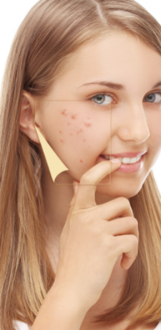 Acne special cream (Kem đặc trị mụn)